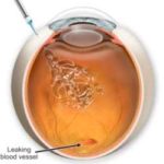 lucentis e retinopatia diabetica