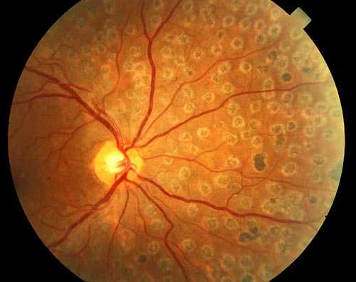 laser retina