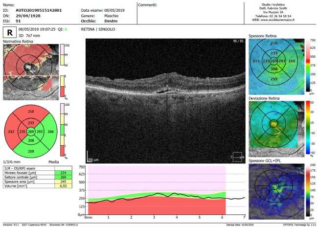 tomografia ottica oct