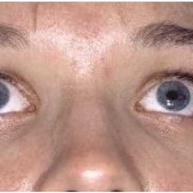 sindrome dell'occhio secco