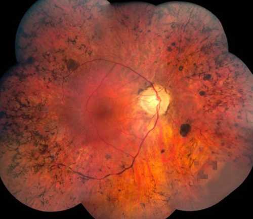 retinite pigmentosa